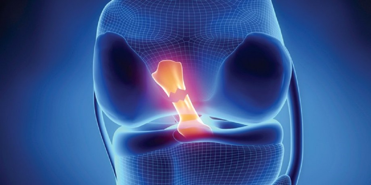 تشخیص رباط صلیبی قدامی سالم و آسیب دیده با استفاده از پردازش تصاویر MRI توسط شبکه های عصبی